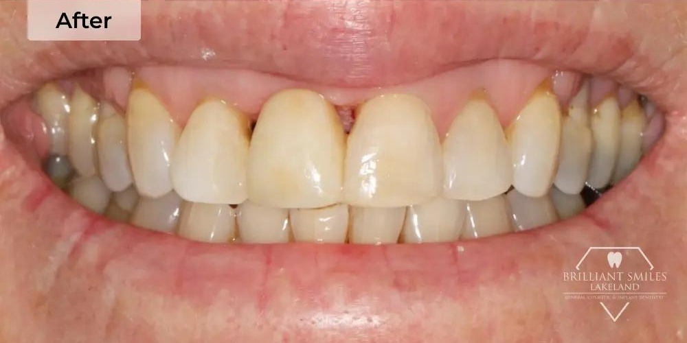 After Treatment Result