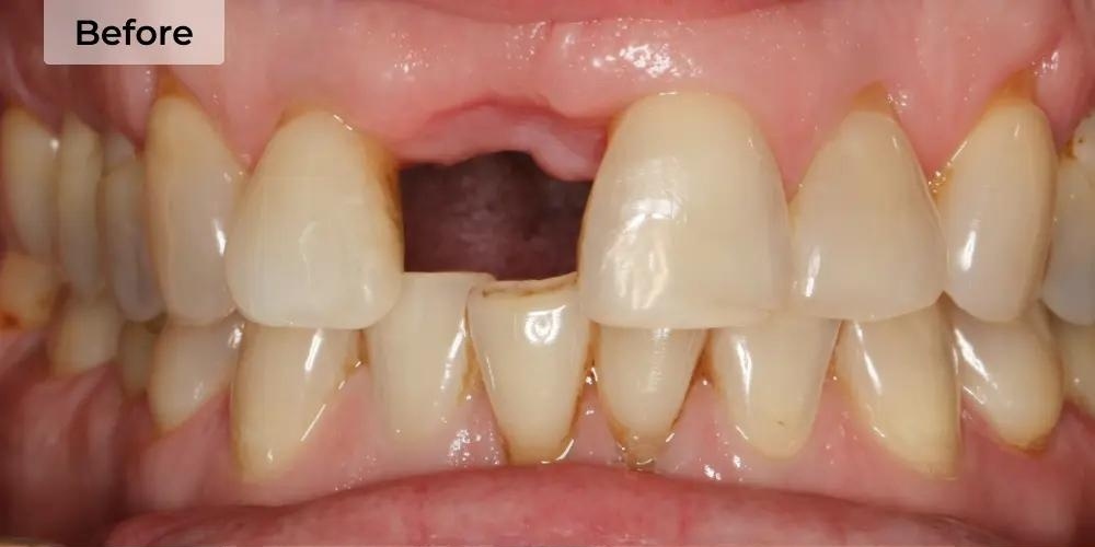 Before Treatment