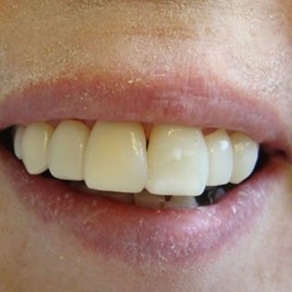 Porcelain Crowns & Bridge Work