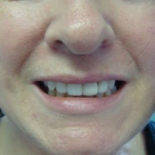 Tooth-Coloured Composite Fillings
