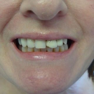 Before Treatment