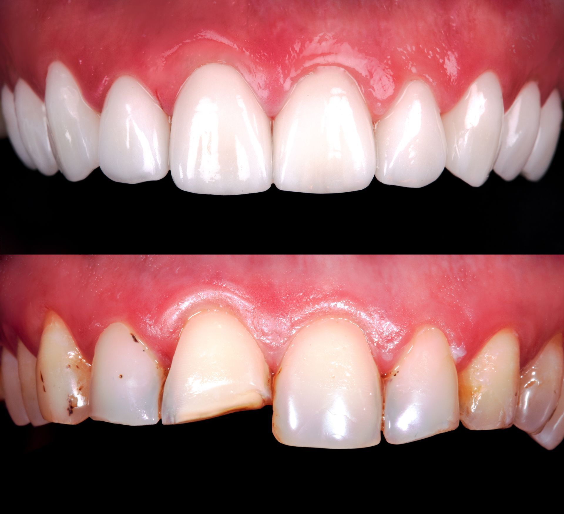 Root Canal Endodontics